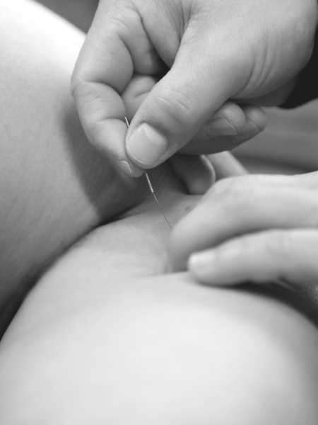 Dry Needling Lijfkracht